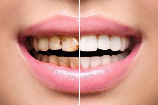 تفاوت ایمپلنت  و لمینت دندان